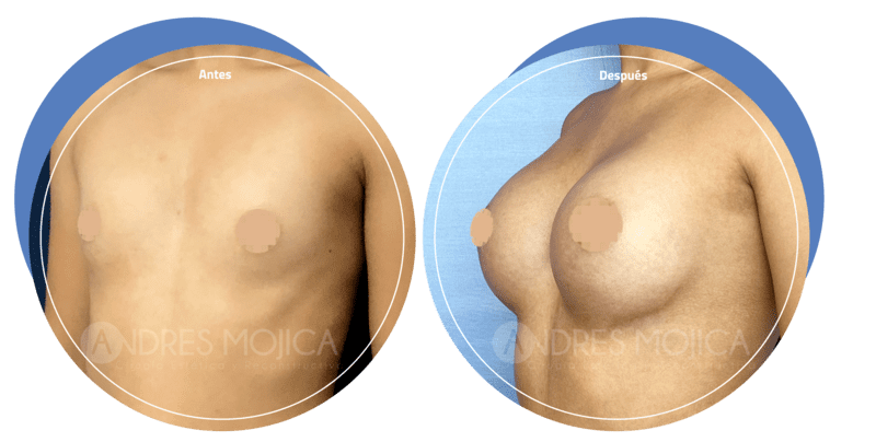 Mamoplastia