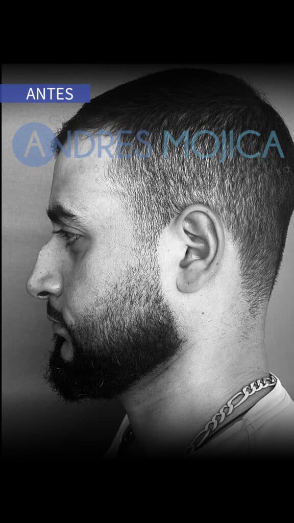 rinoplastia antes y despues​