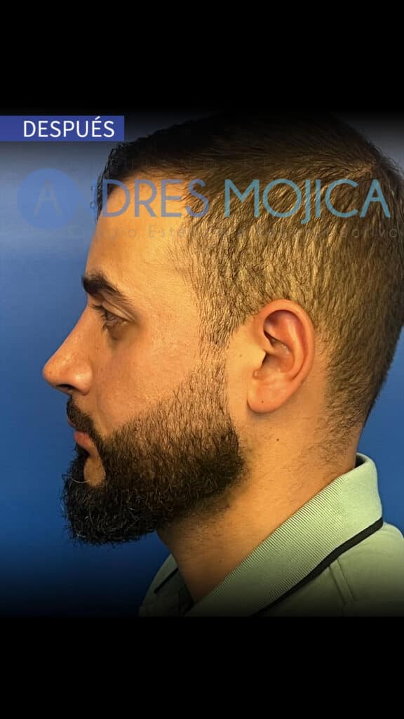 rinoplastia antes y despues​