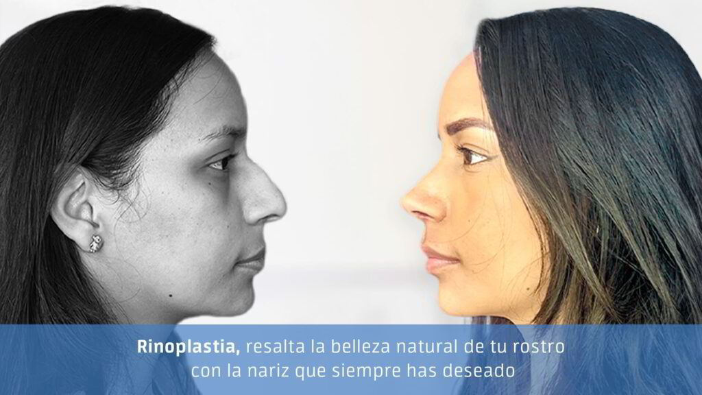 Rinoplastia