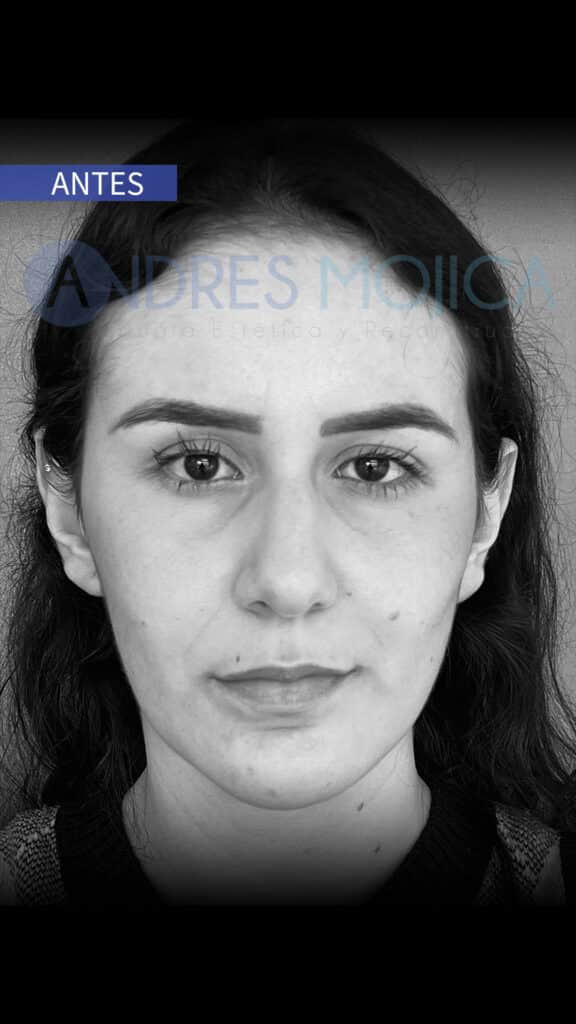 rinoplastia antes y despues​