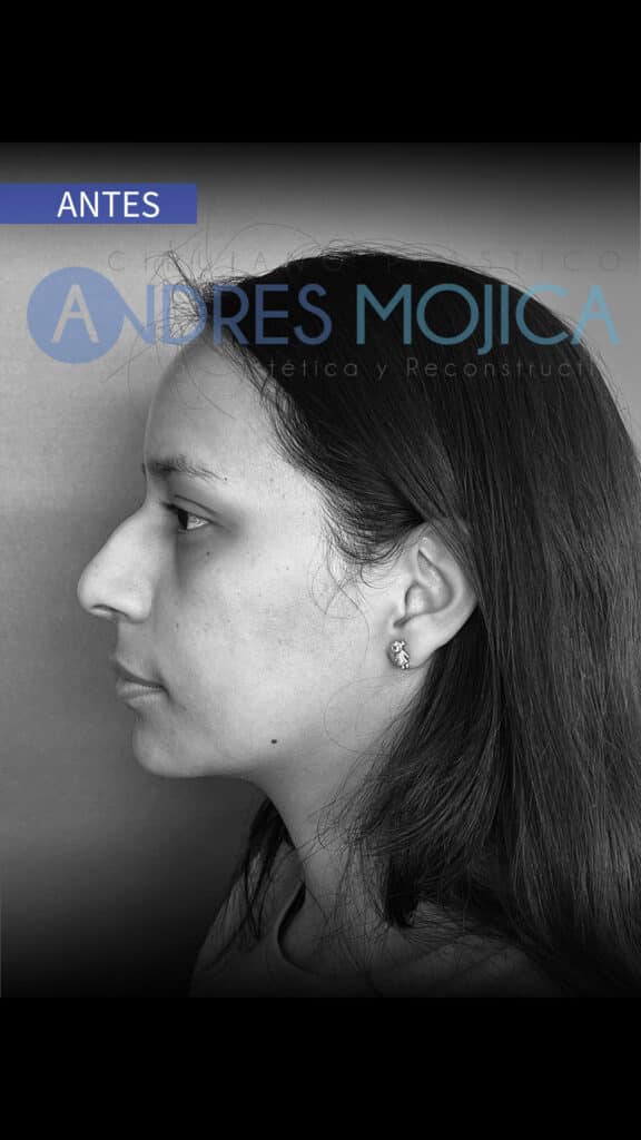 rinoplastia antes y despues​