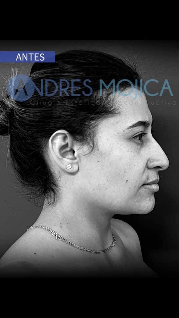 rinoplastia antes y despues​