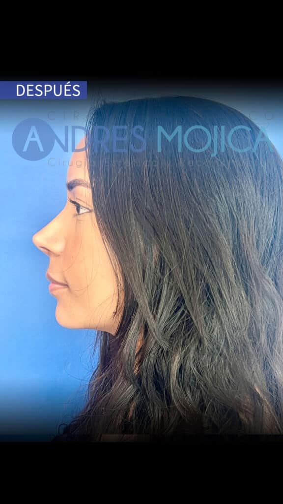 rinoplastia antes y despues​