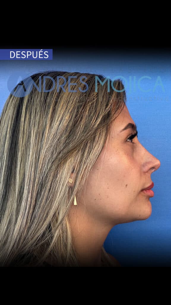 rinoplastia antes y despues​
