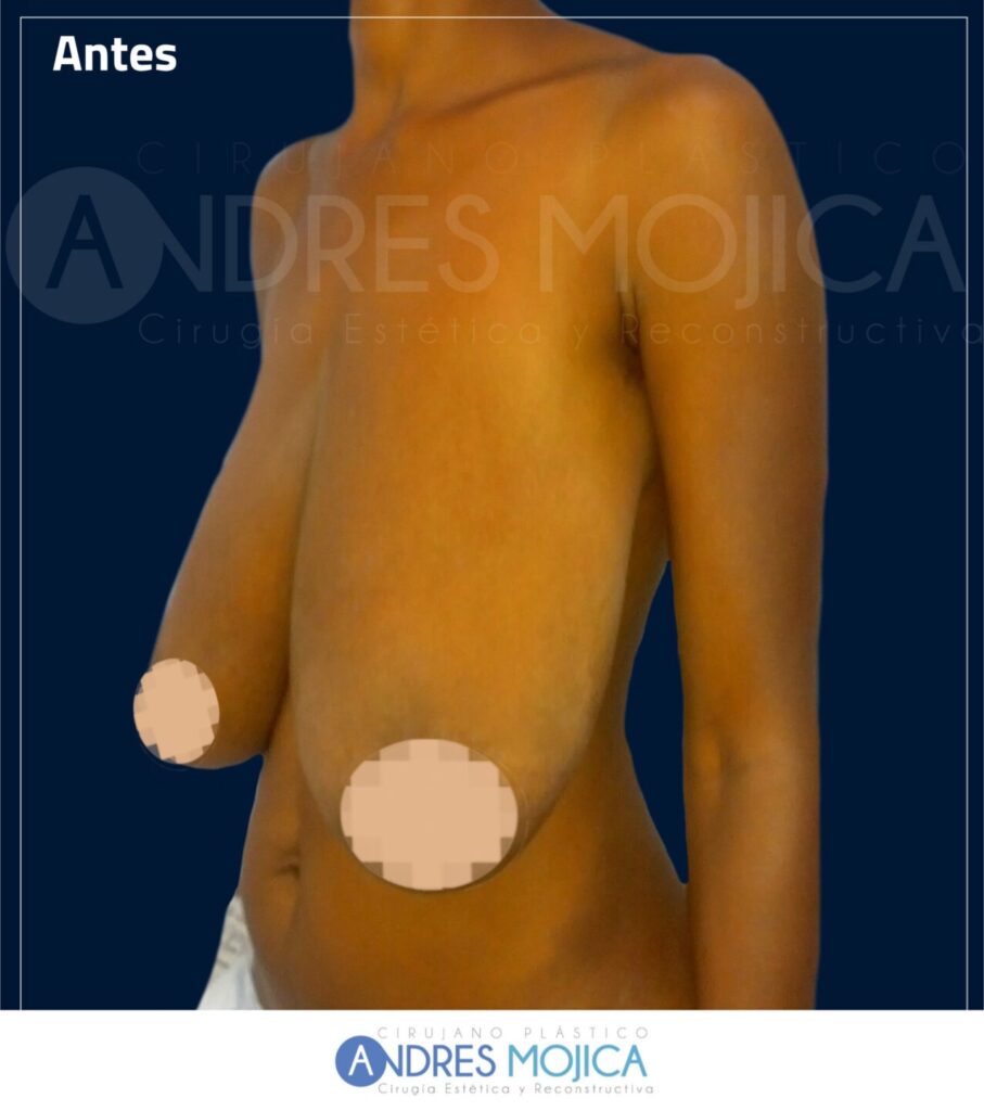 Mamoplastia Antes y Despues