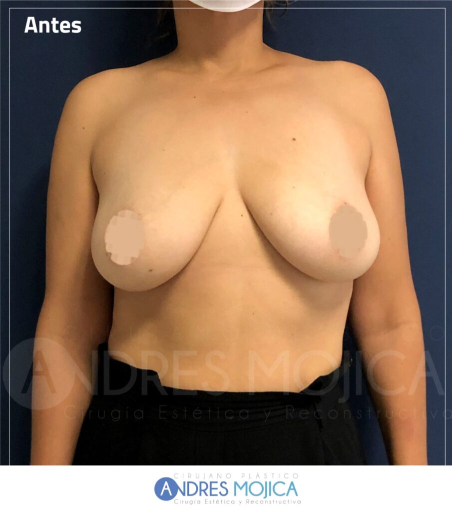 Mamoplastia Antes y Despues