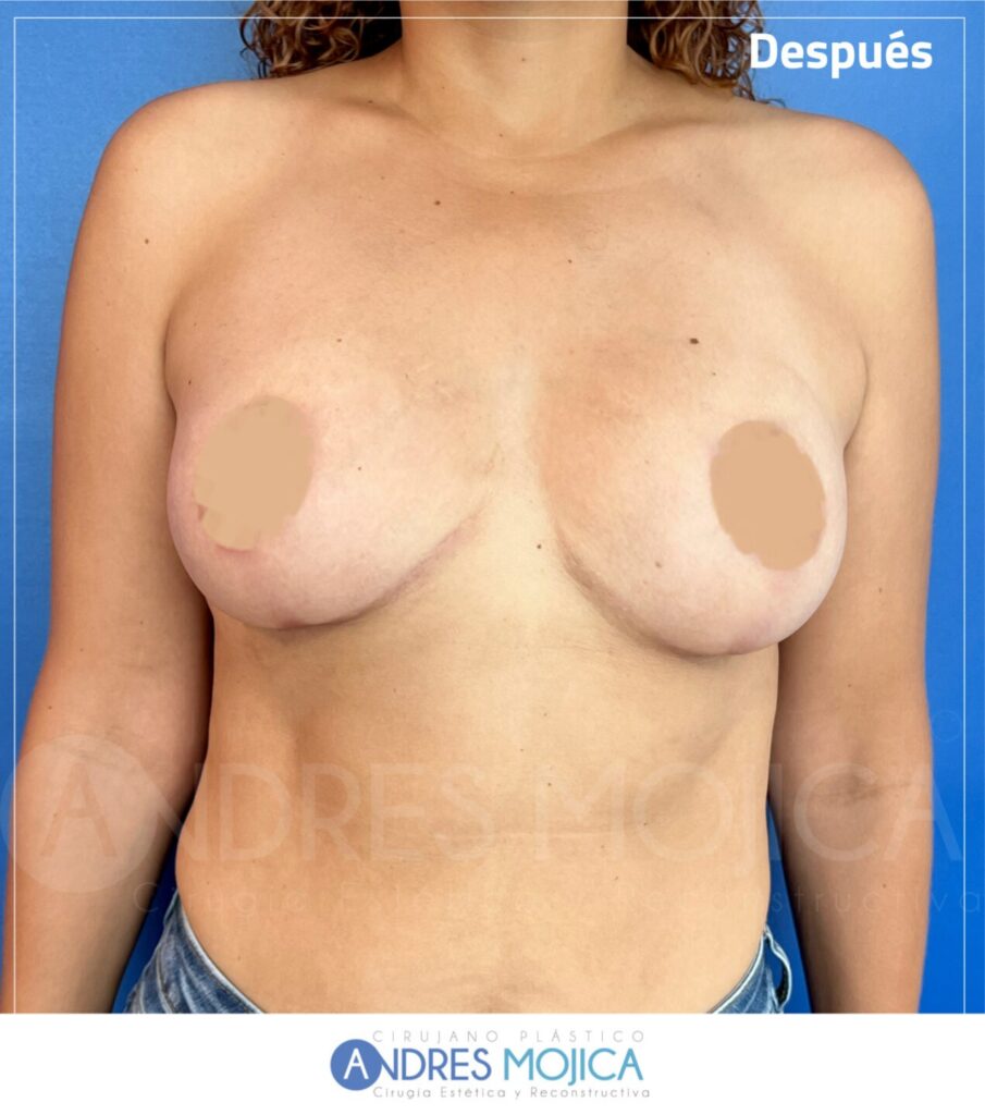 Mamoplastia Antes y Despues