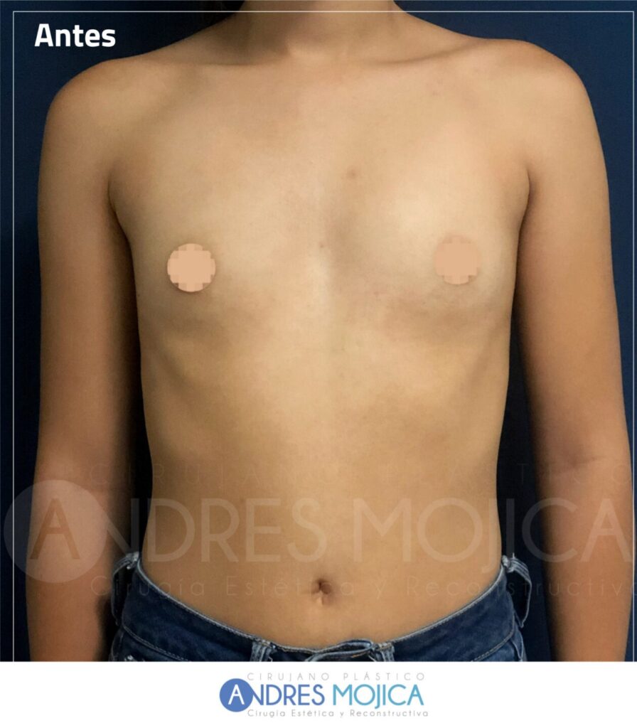 Mamoplastia Antes y Despues