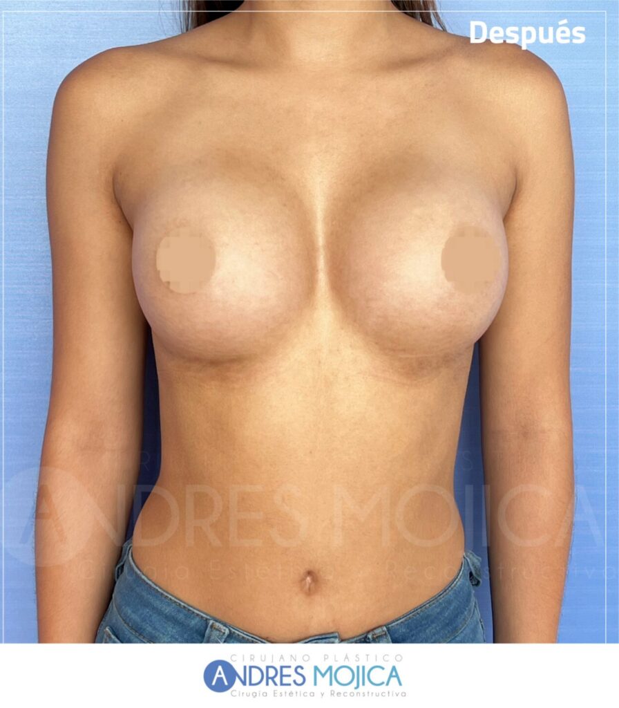 Mamoplastia Antes y Despues