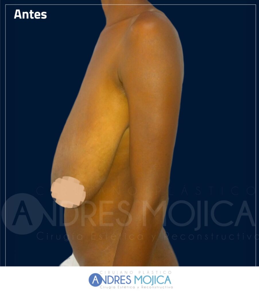 Mamoplastia Antes y Despues