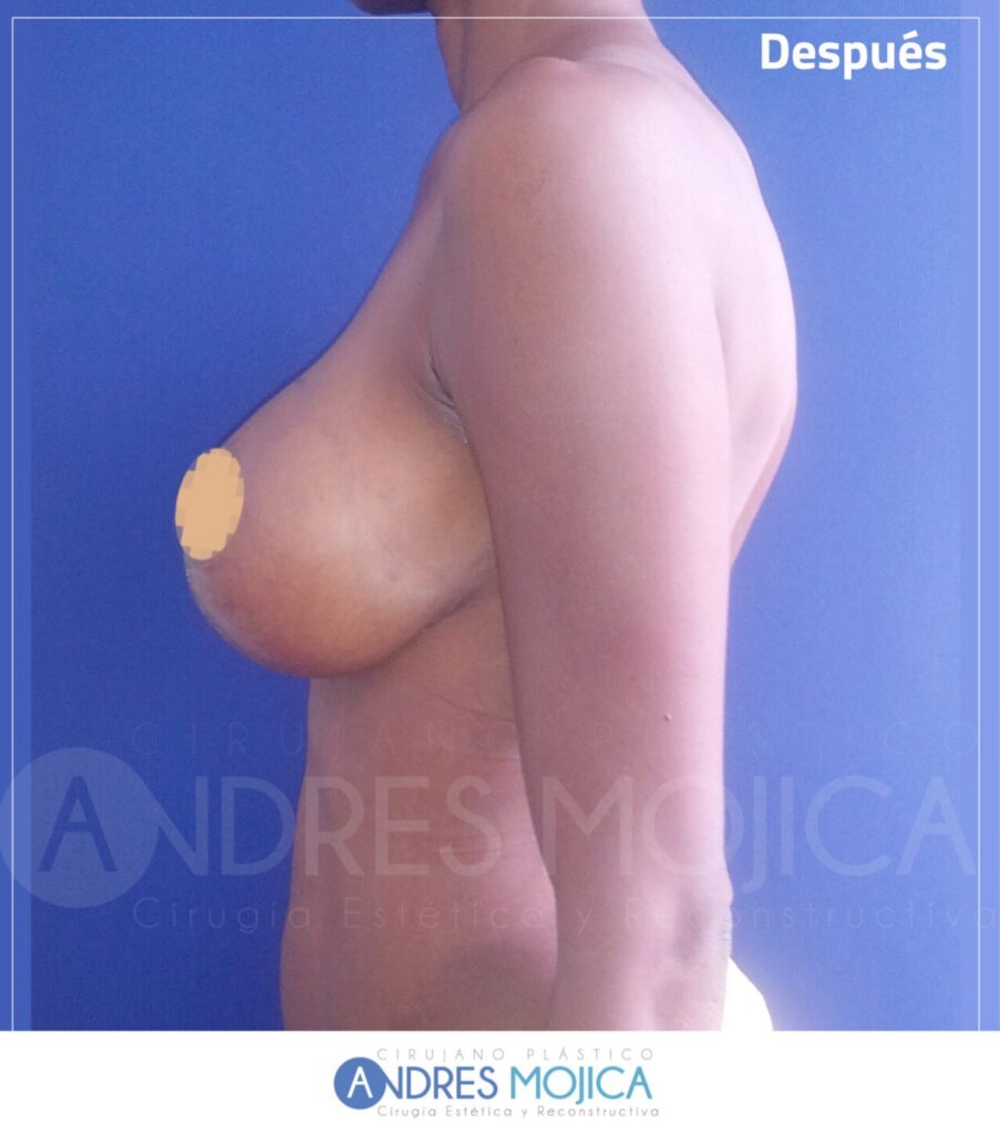 Mamoplastia Antes y Despues