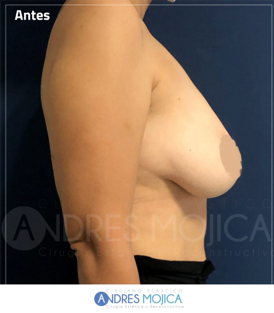 Mamoplastia Antes y Despues