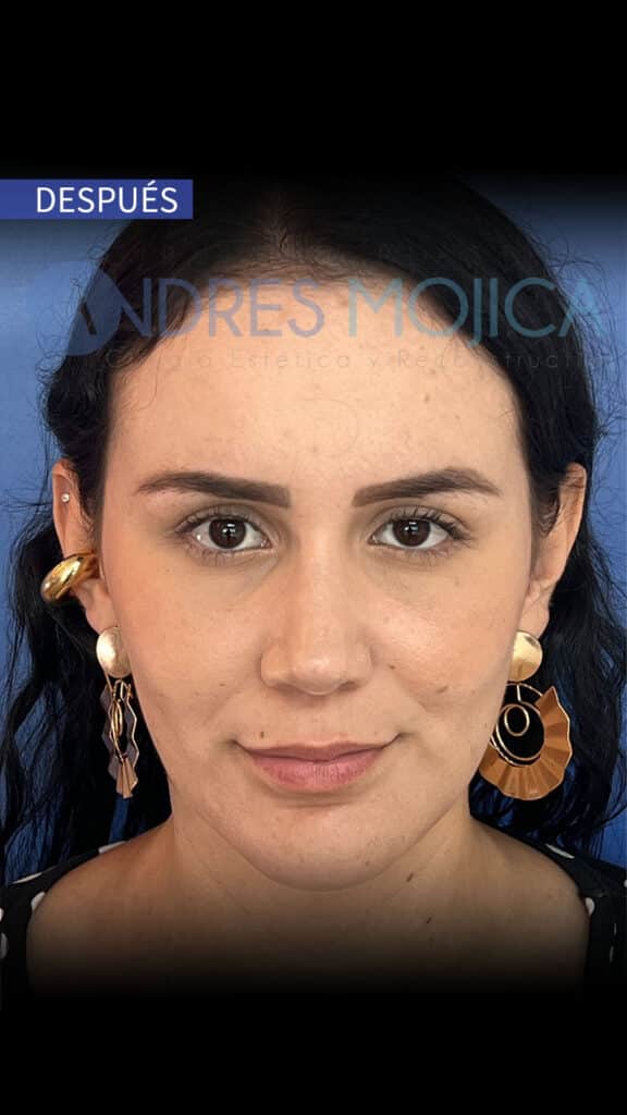rinoplastia antes y despues​