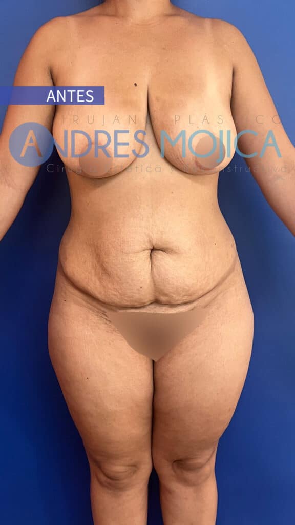 Abdominoplastia Antes y Despues