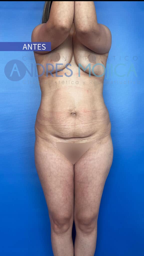 Abdominoplastia Antes y Despues
