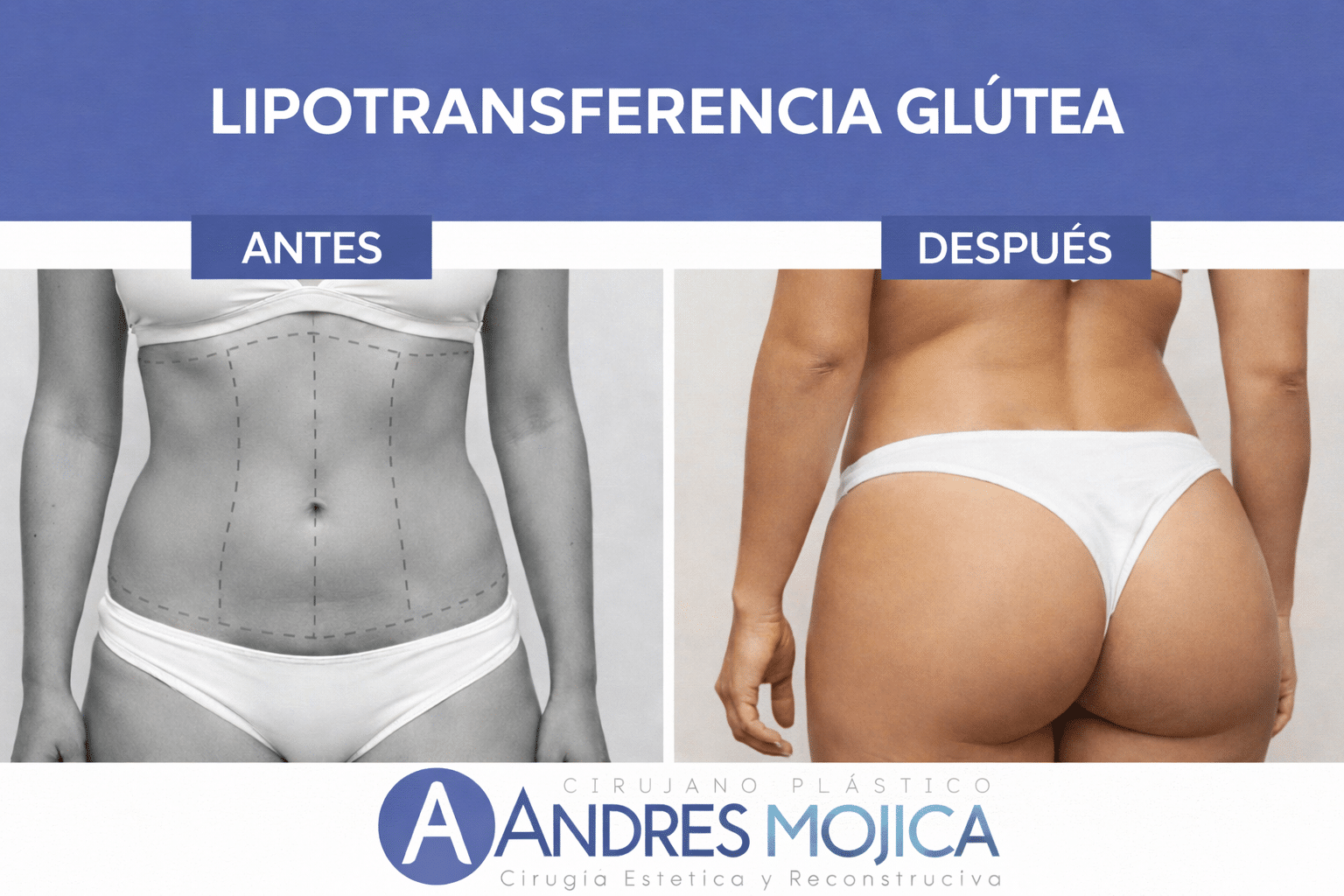 lipoinyección glútea
